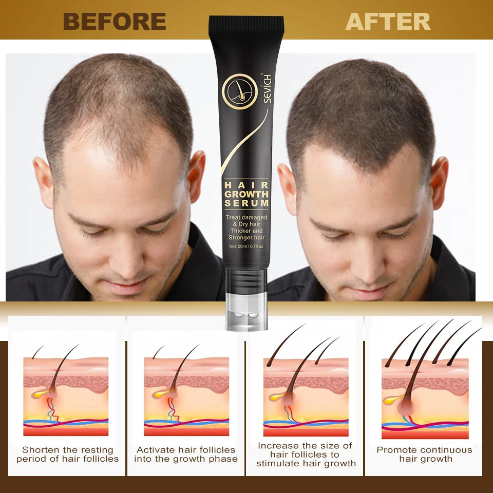 Sevich Herbal Fast Hair Growth Oil With Massage Roller 20ml Hair Loss Treatment Ginger Extract Growing Serum Hair Loss Products
