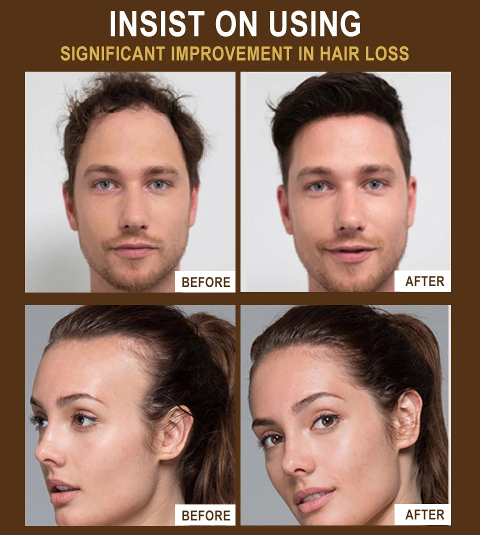 Sevich Herbal Fast Hair Growth Oil With Massage Roller 20ml Hair Loss Treatment Ginger Extract Growing Serum Hair Loss Products