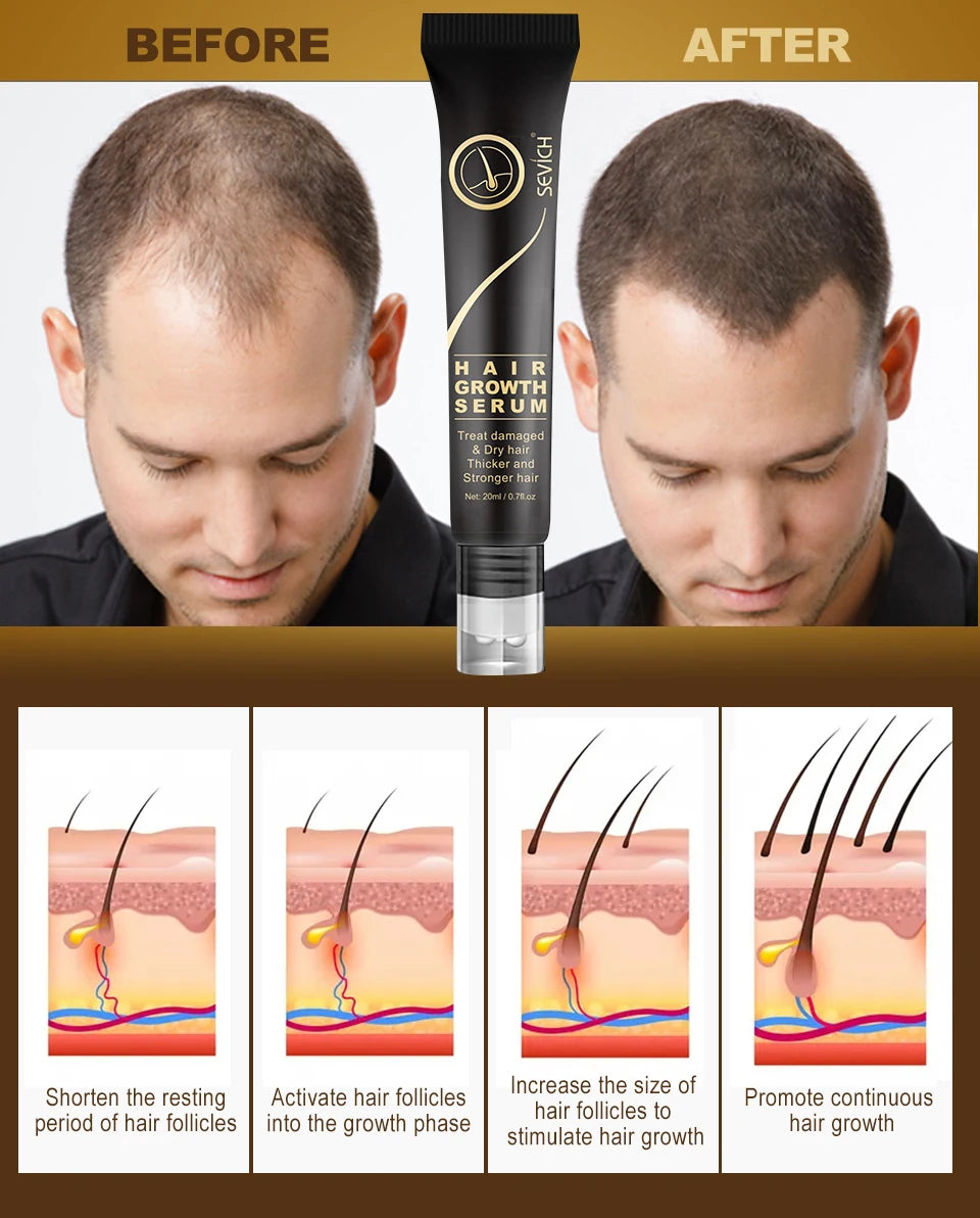 Sevich Herbal Fast Hair Growth Oil With Massage Roller 20ml Hair Loss Treatment Ginger Extract Growing Serum Hair Loss Products