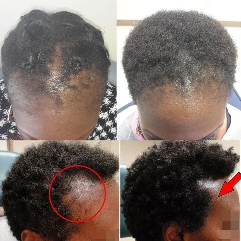 Hairs Care Serum Oil Baldness Repair Hereditary Hair Loss Postpartum Hair Loss Seborrheic Hairs Loss Hair Oil