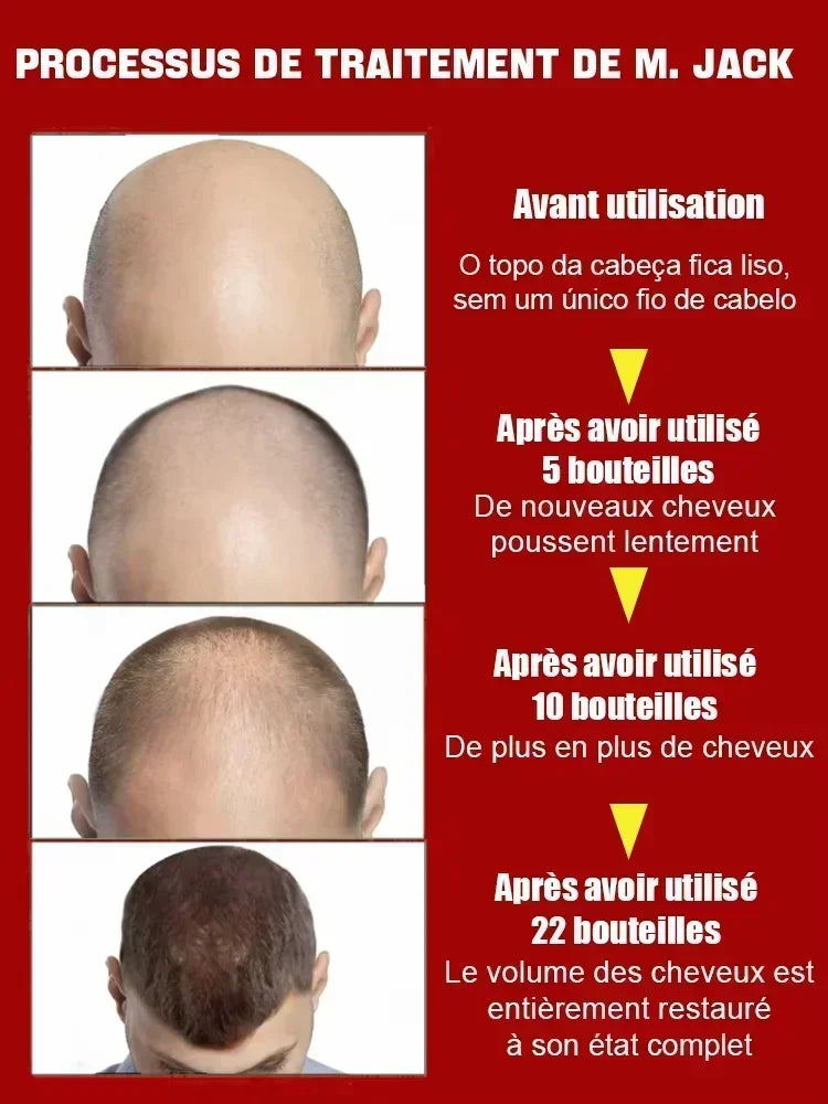 Hairs Care Serum Oil Baldness Repair Hereditary Hair Loss Postpartum Hair Loss Seborrheic Hairs Loss Hair Oil