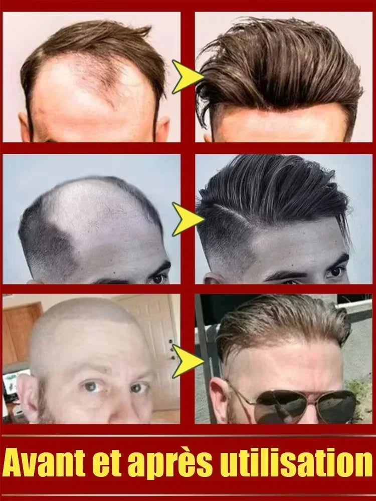 Hairs Care Serum Oil Baldness Repair Hereditary Hair Loss Postpartum Hair Loss Seborrheic Hairs Loss Hair Oil