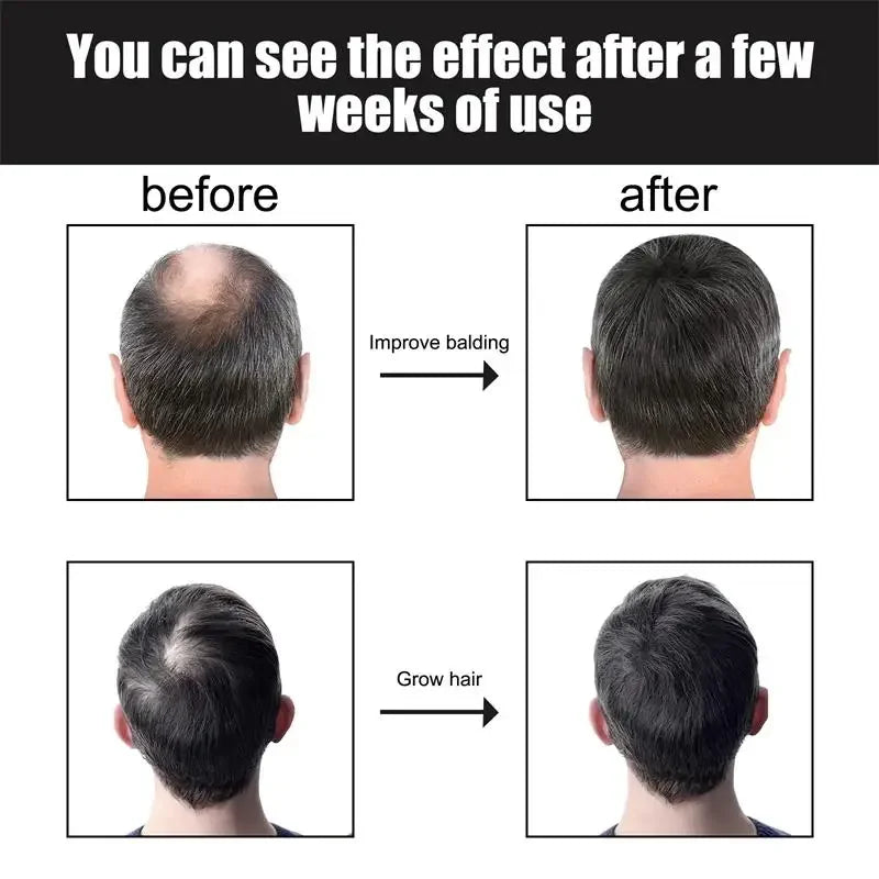 Hair Growth Oil Fast Hair Growth Effective Baldness Repair Hereditary Hair Loss Postpartum