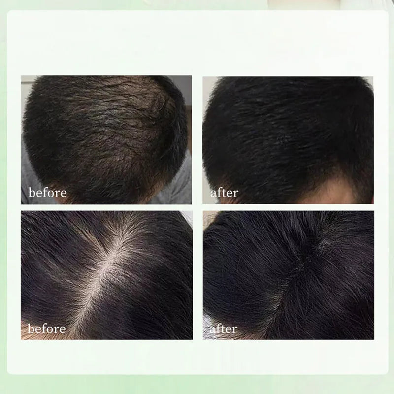 Natural Hair Loss Control Soap Hair Loss Control Oil Control Activates Follicles Handmade Herbal Shampoo Bar For Men Women