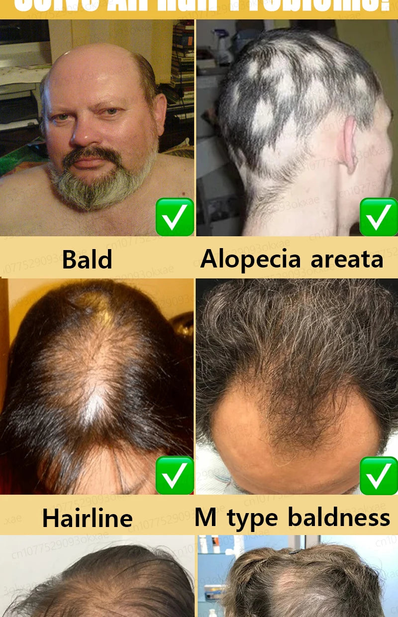 No longer worry about baldness, you will grow thick hair by using this product
