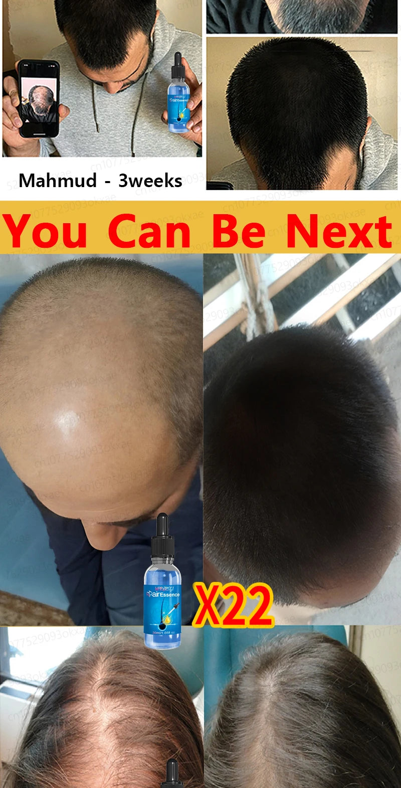 No longer worry about baldness, you will grow thick hair by using this product